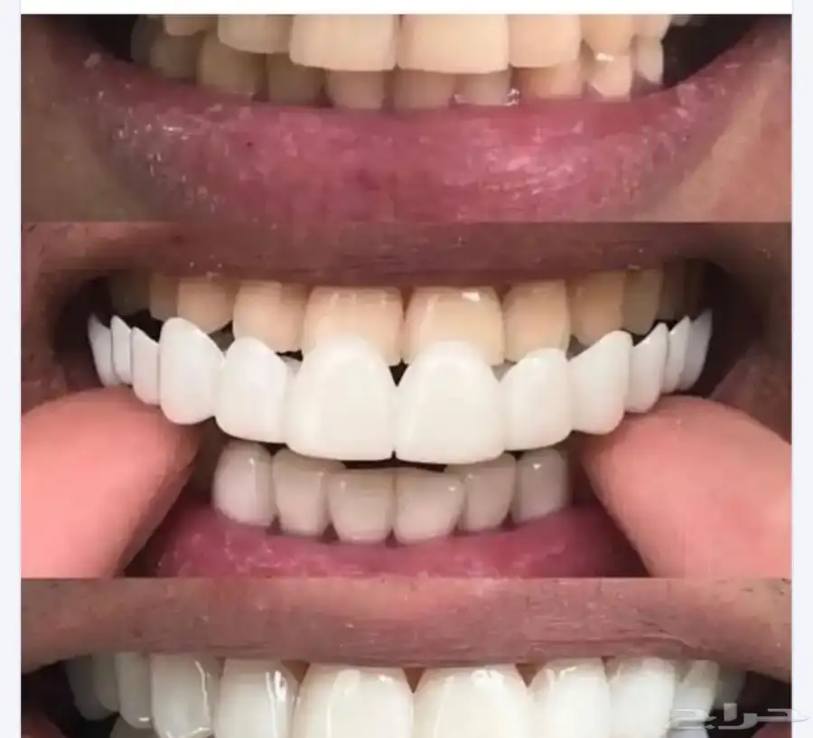 قالب اسنان ابتسامة هوليوود 3