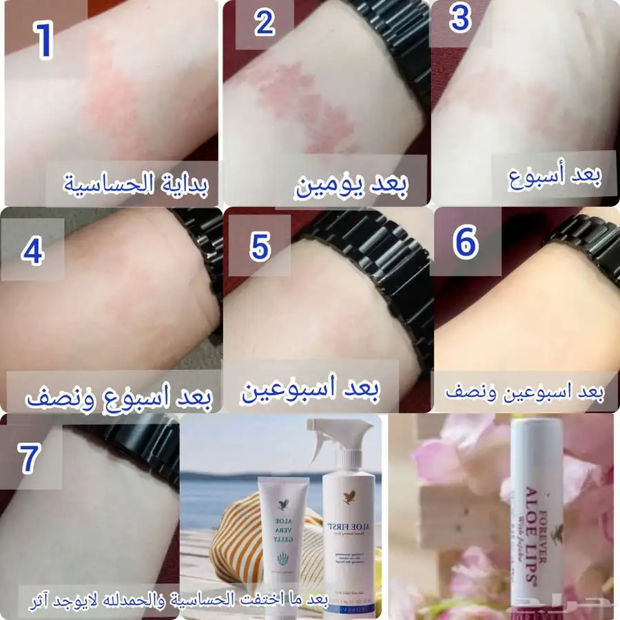 البيع الاكزيما 2
