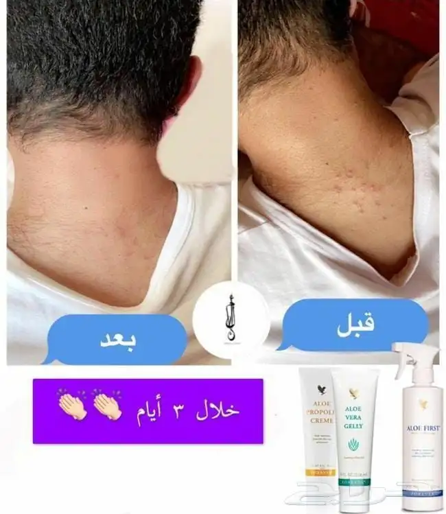 البيع الاكزيما 5