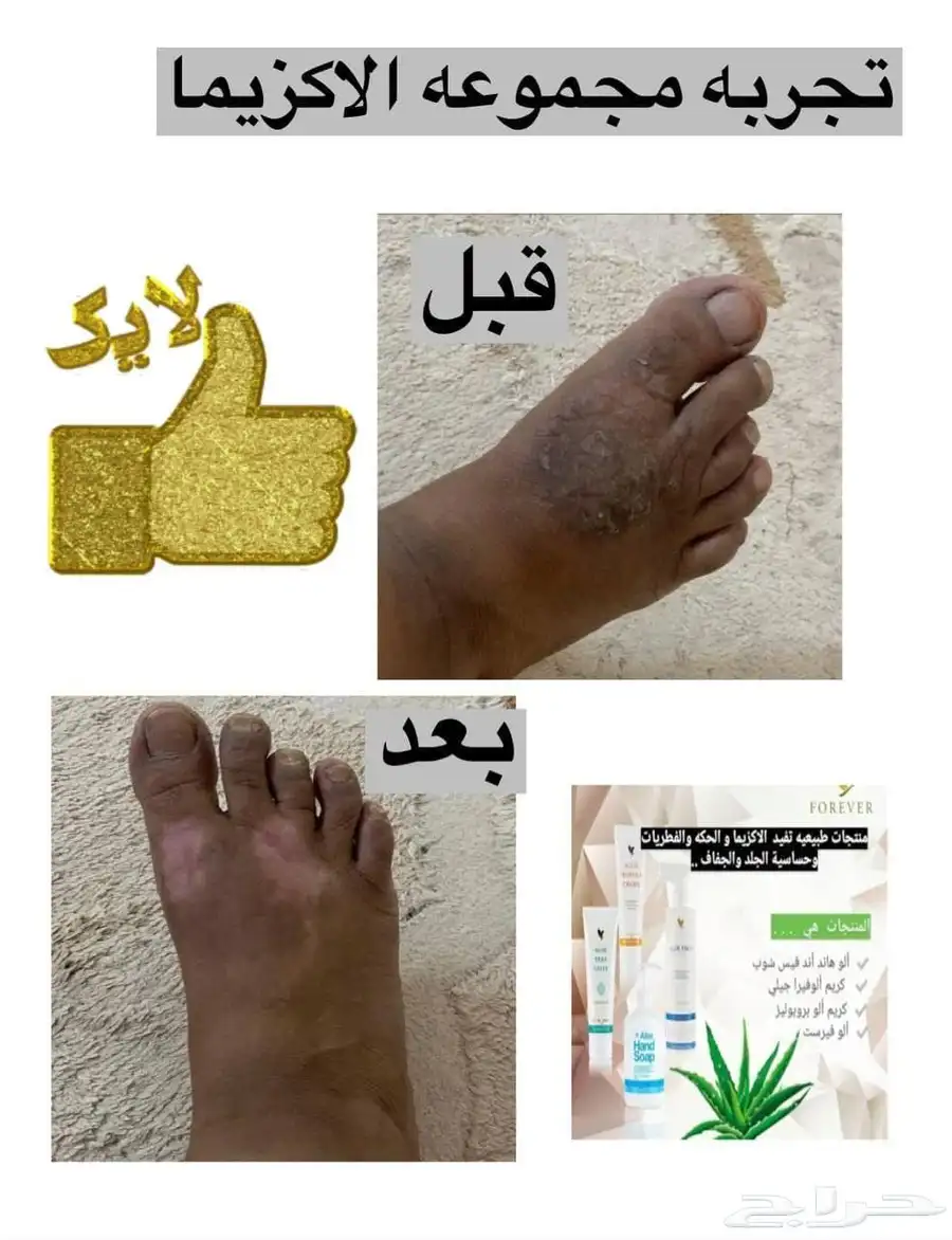 البيع الاكزيما 0