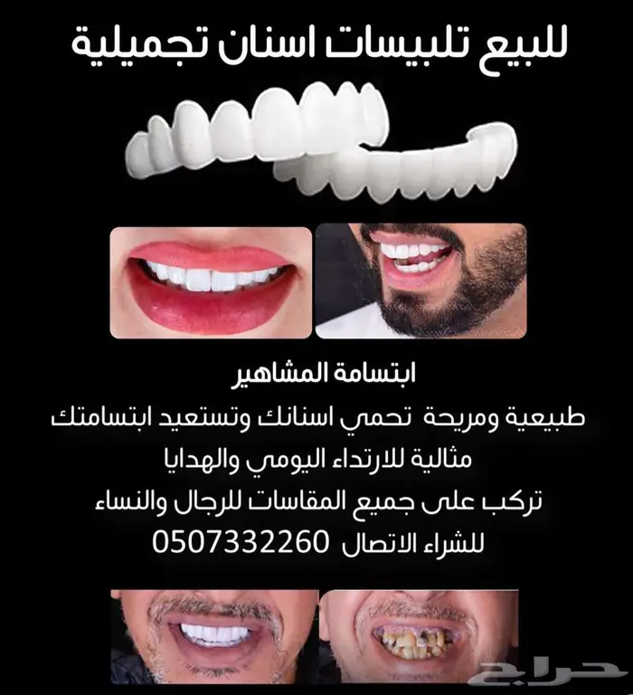 للبيع تلبيسات اسنان تجميلية 0