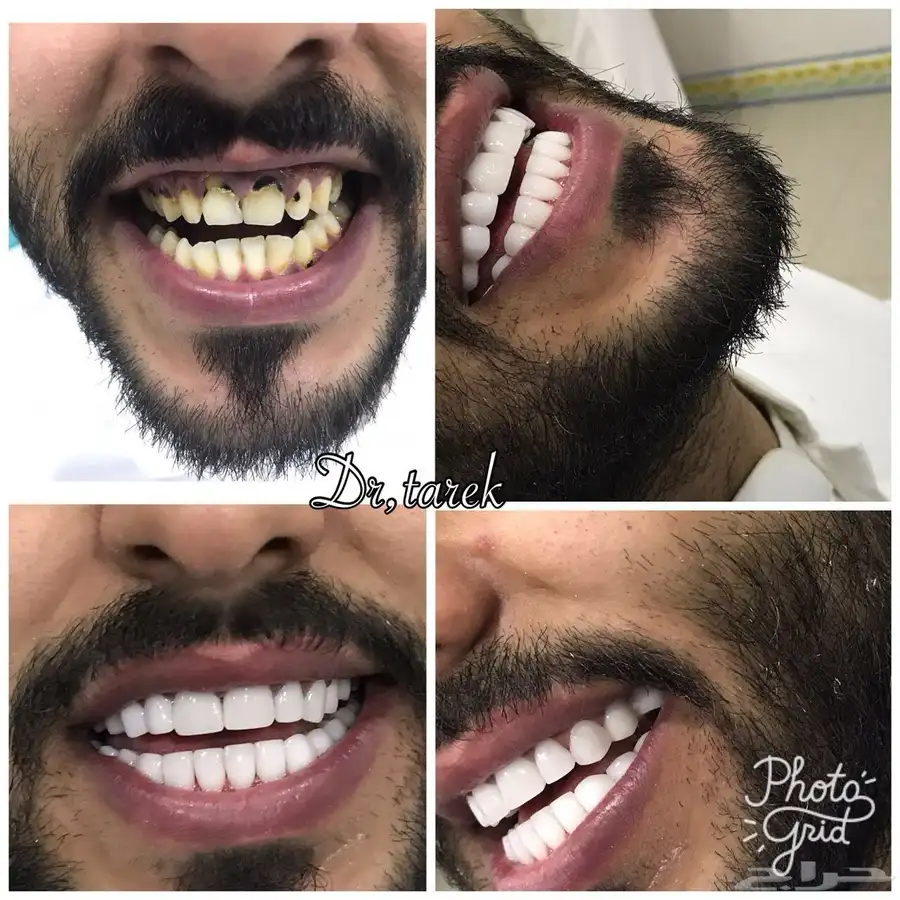الفينير المتحركة 2