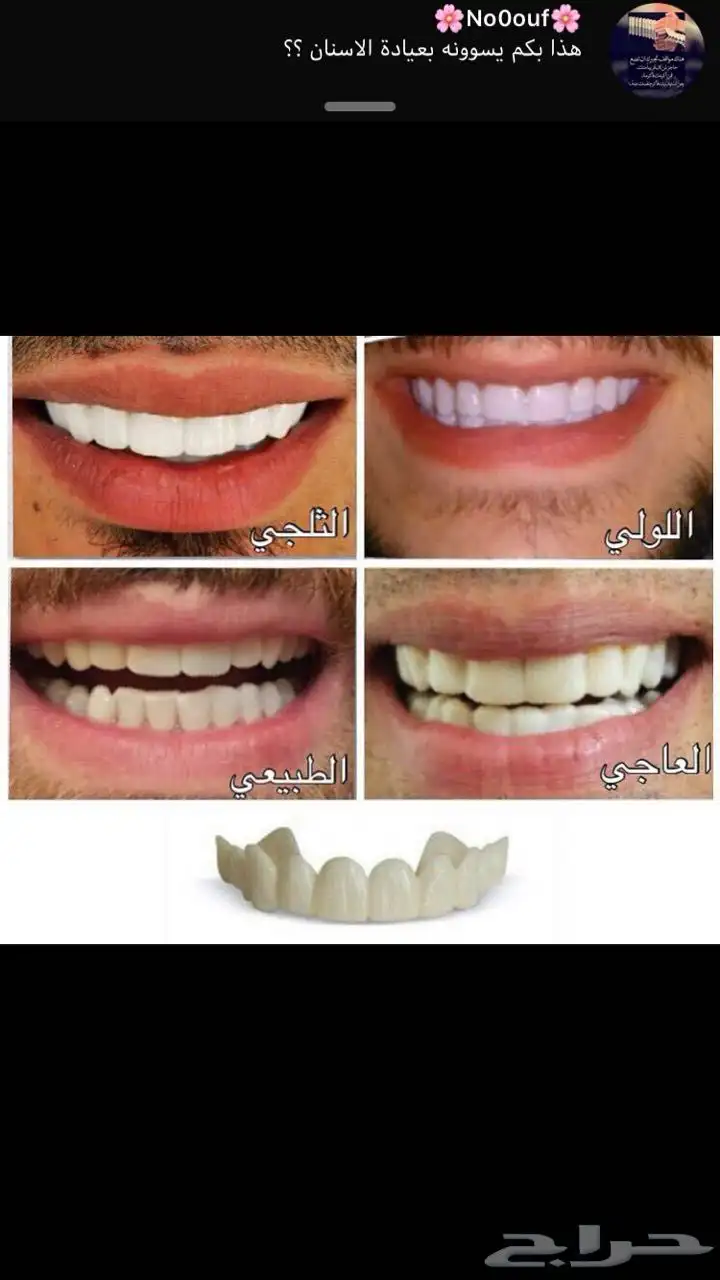 الفينير المتحركة 3