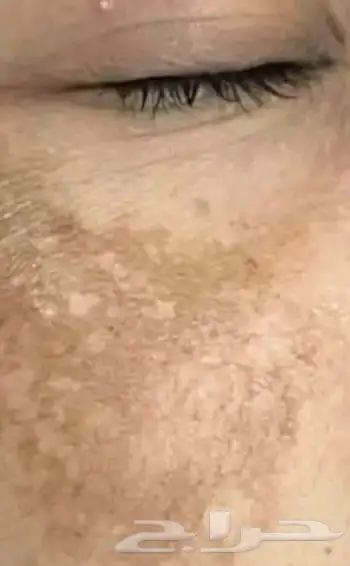 كريم تفتيح البشرة 1
