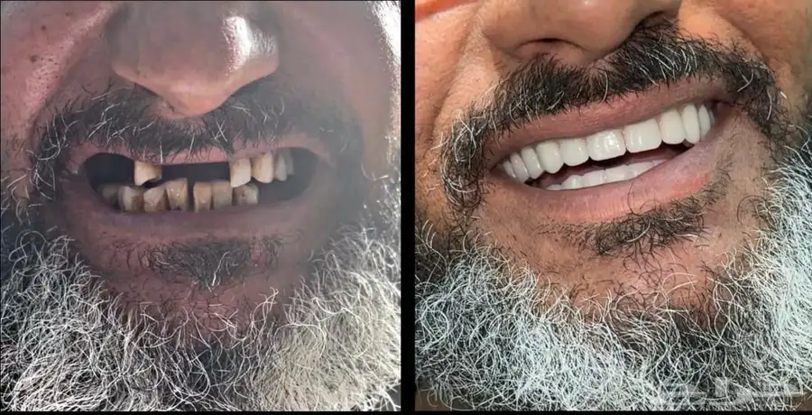 طقم متحرك لتعويض الأسنان المفقوده 0