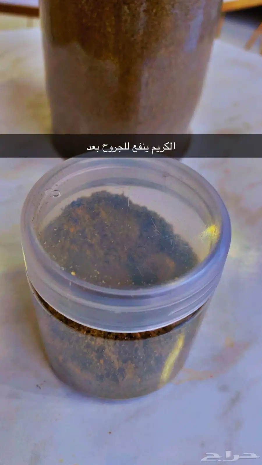 لناسور 0