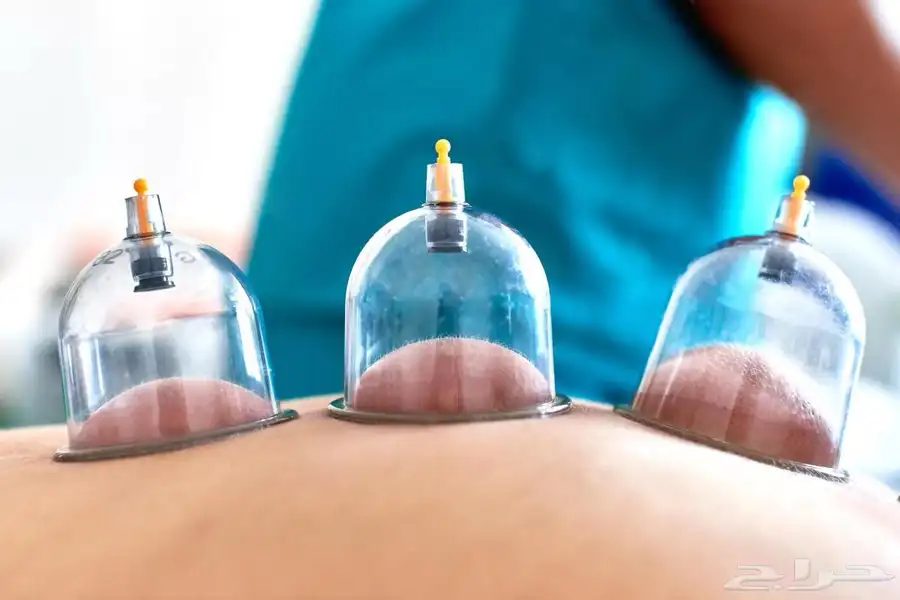 حجامة منزليه وعلاج طبيعي 0