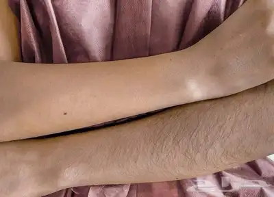 منتج ازالة الشعر 1