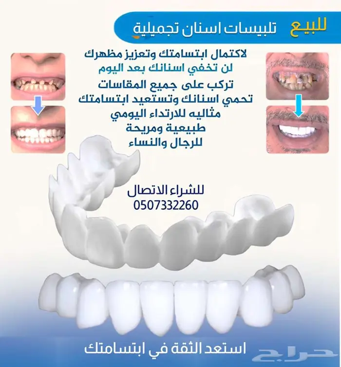 للبيع تلبيسات اسنان تجميلية 0