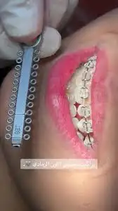 تقويم اسنان زينه 3