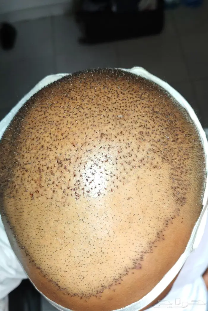 مركز رويال لزراعة الشعر بمصر 0