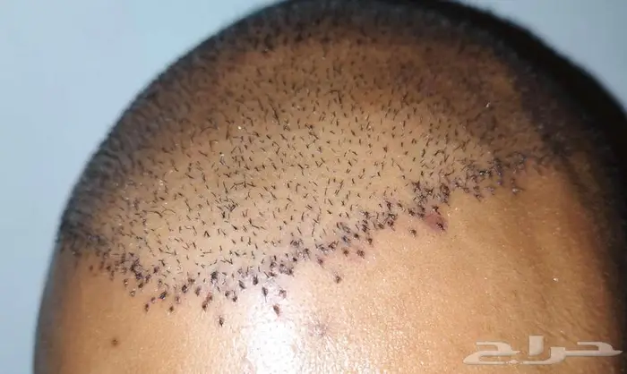 مركز رويال لزراعة الشعر بمصر 1
