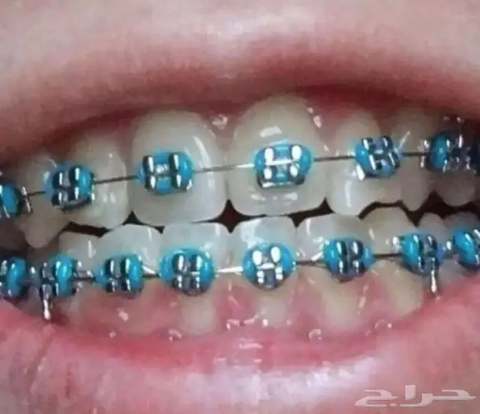 تقويم اسنان مع التركيب 2