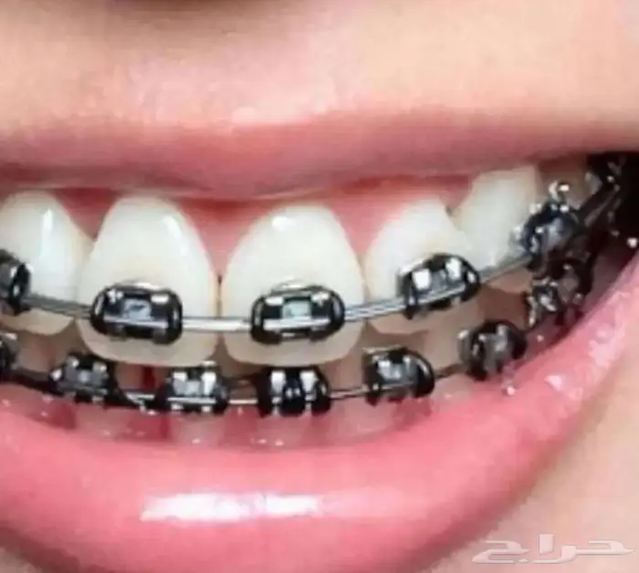 تقويم اسنان مع التركيب 0