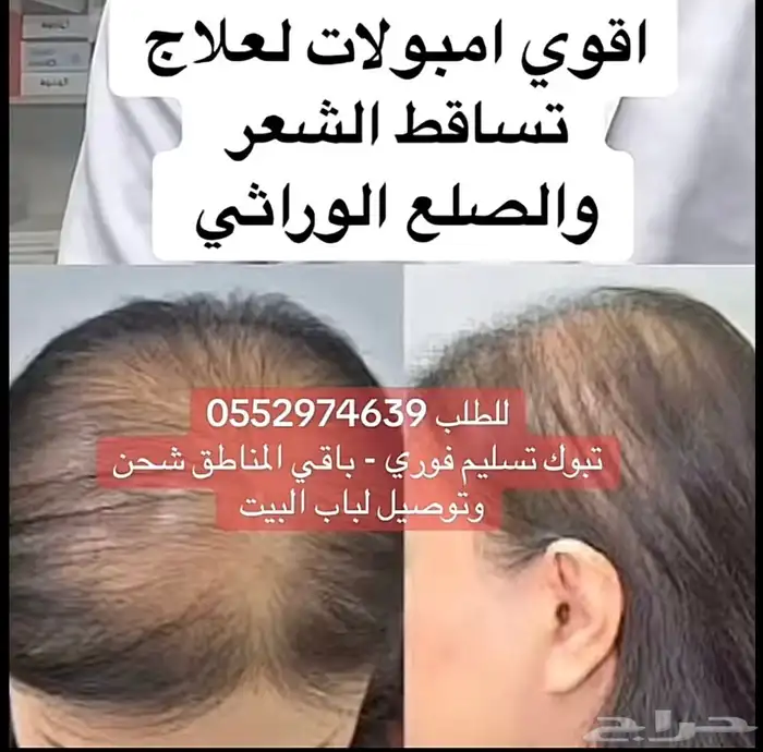 معالج تساقط الشعر - الثعلبه - فراقات الشعر 2