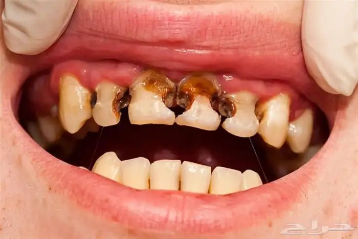 علاج عصب للاسنان الامامية مجانا 0