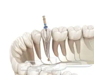 علاج عصب مجاني لجميع الاسنان ماعدا الطواحن 0