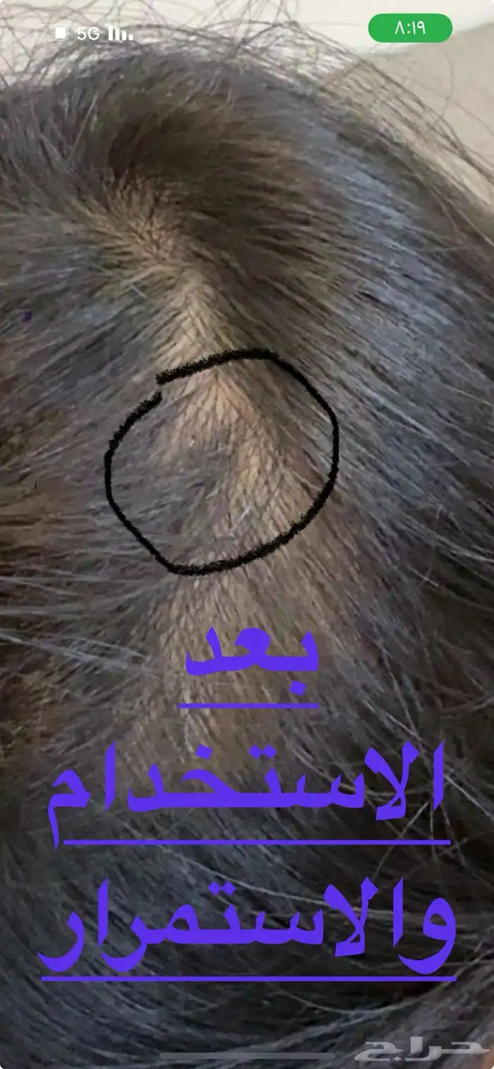 زيت لشعر لعلاج الثعلبه 2