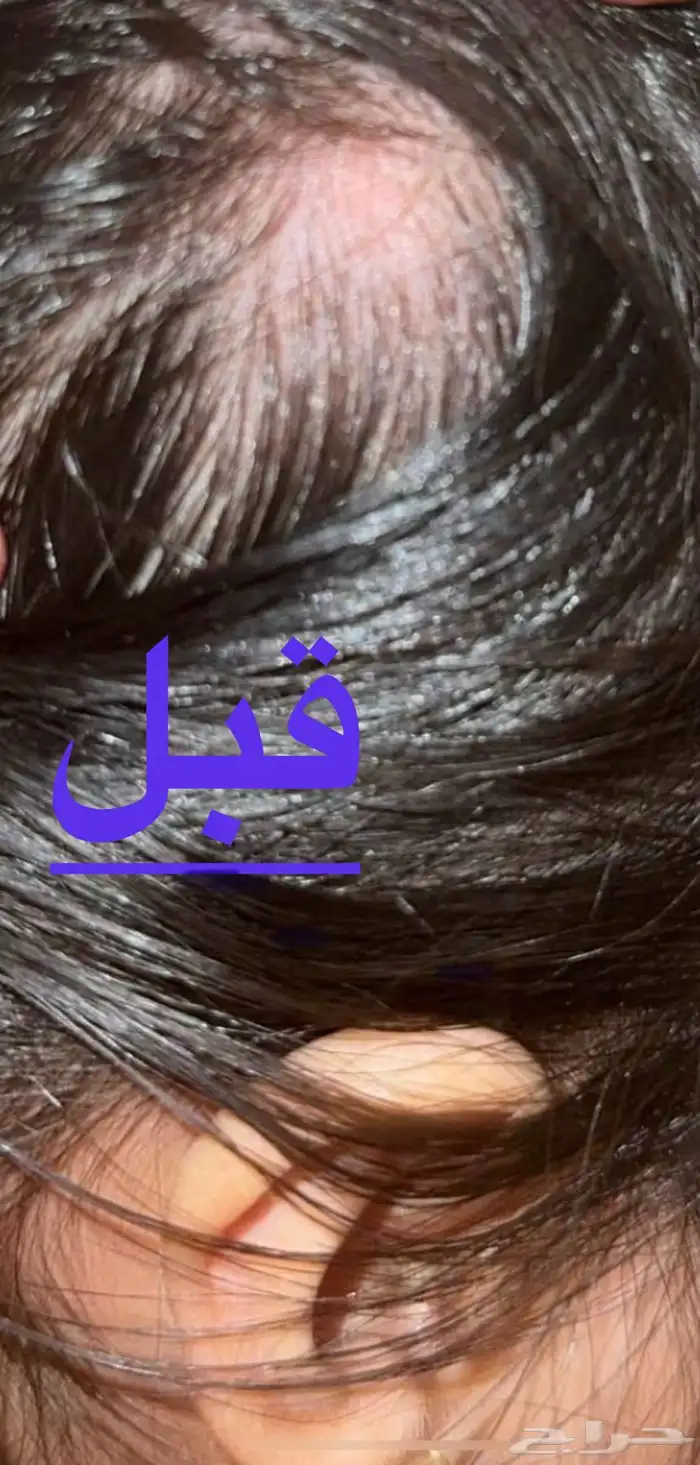 زيت لشعر لعلاج الثعلبه 0