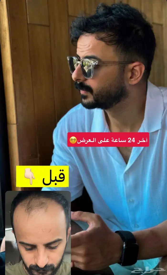 أفضل عيادة زراعة شعر في تركيا وصاحبها سعودي 7