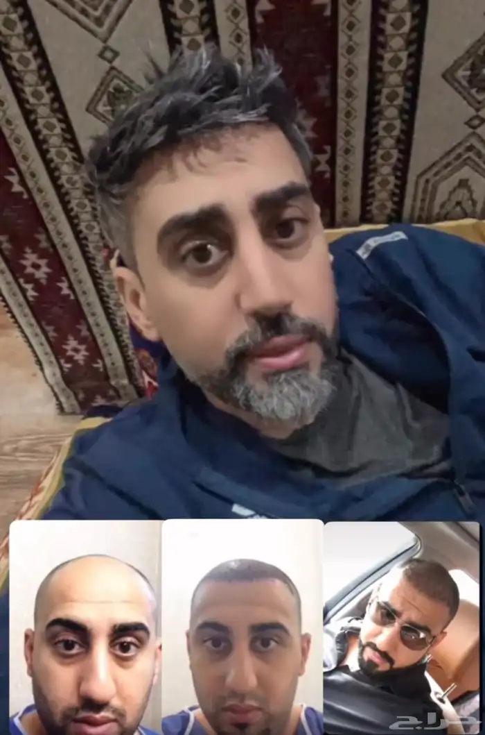 أفضل عيادة زراعة شعر في تركيا وصاحبها سعودي 5