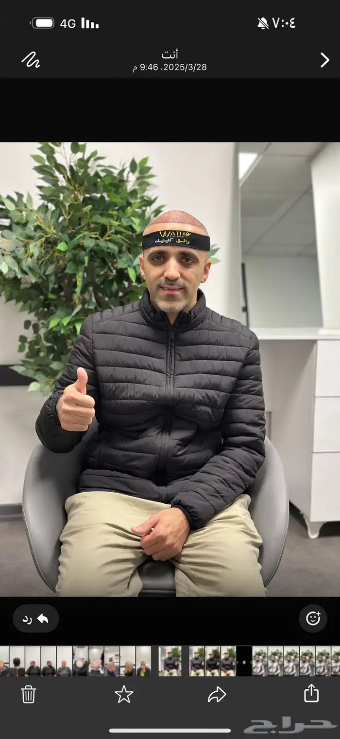 أفضل عيادة زراعة شعر في تركيا وصاحبها سعودي 1