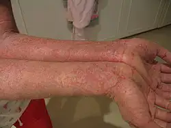 علاج الاكزيما الحساسيه 0