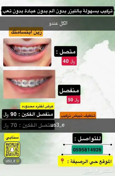 تقويم اسنان مع التركيب 0