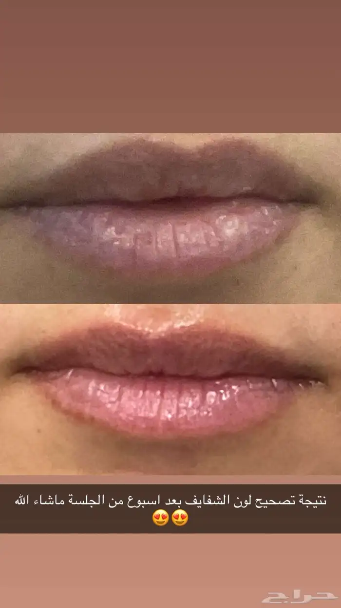 توريد وتصحيح لون شفايف 0