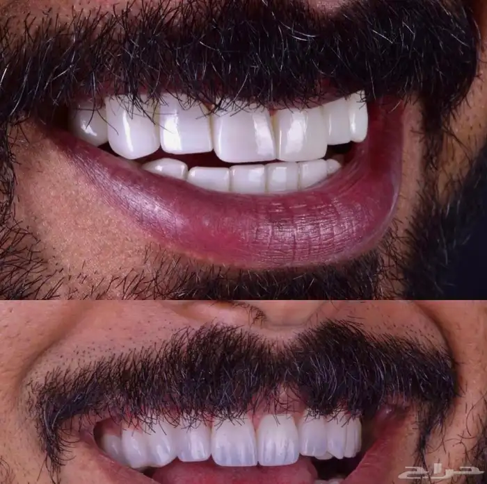 ابتسامه هوليود 1