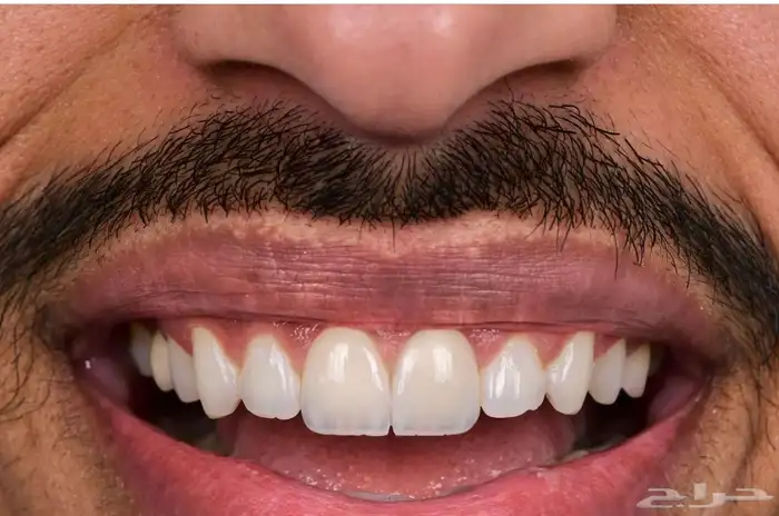 ابتسامه هوليود 0