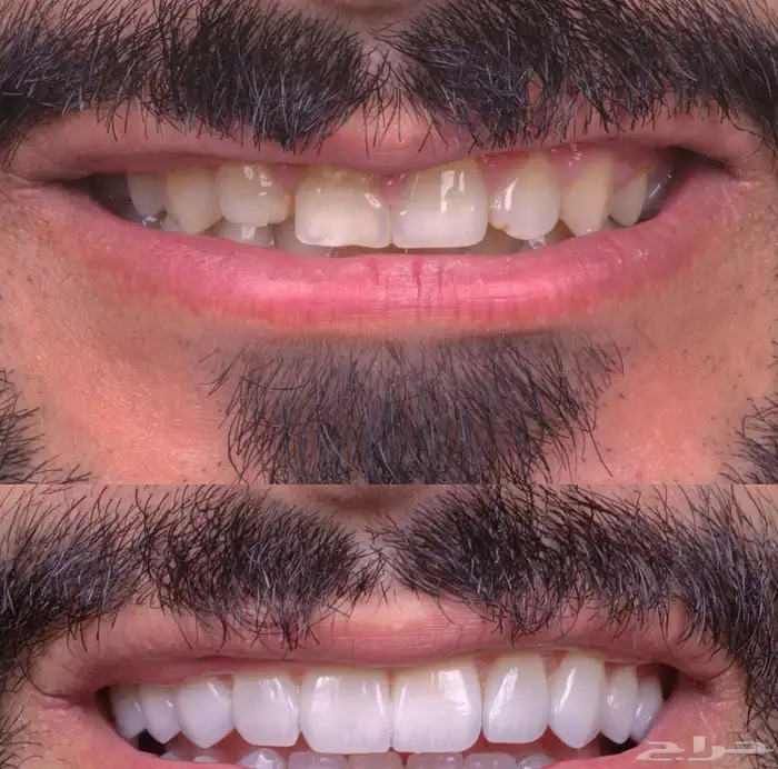 ابتسامه هوليود 5
