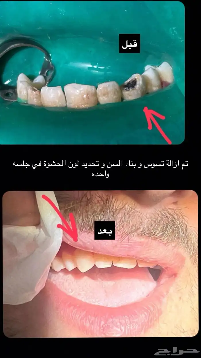 مجاني علاج اسنان الرياض 1