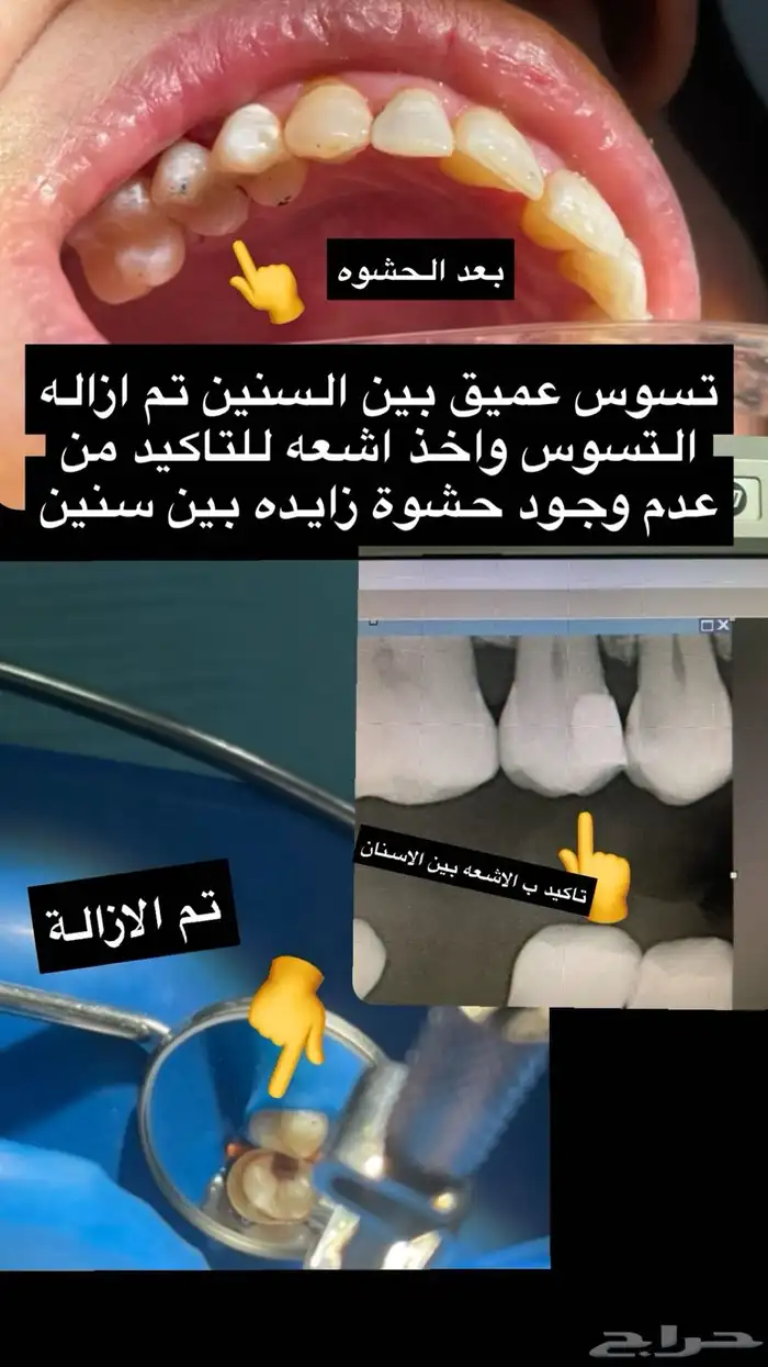 مجاني علاج اسنان الرياض 3