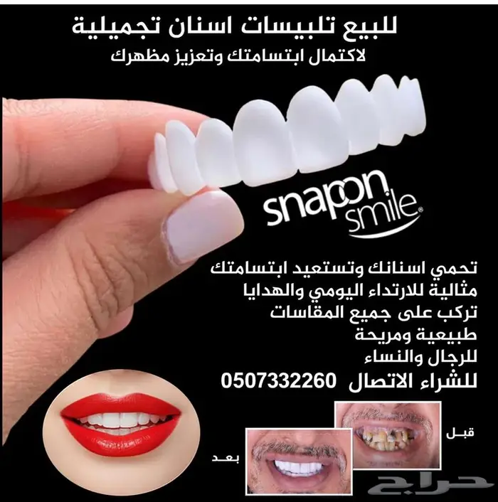 للبيع تلبيسات اسنان تجميلية 0