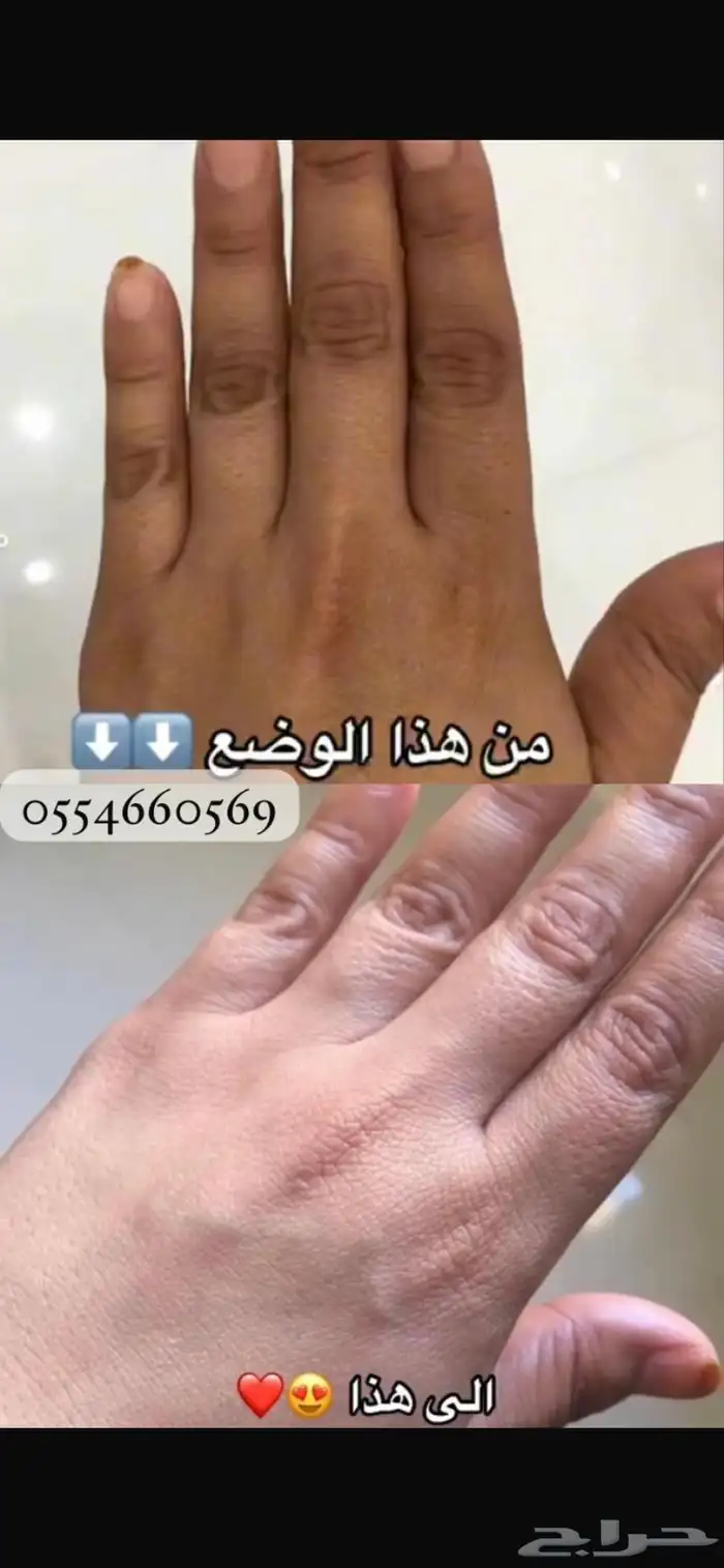 كريمات تبييض في مكة 0
