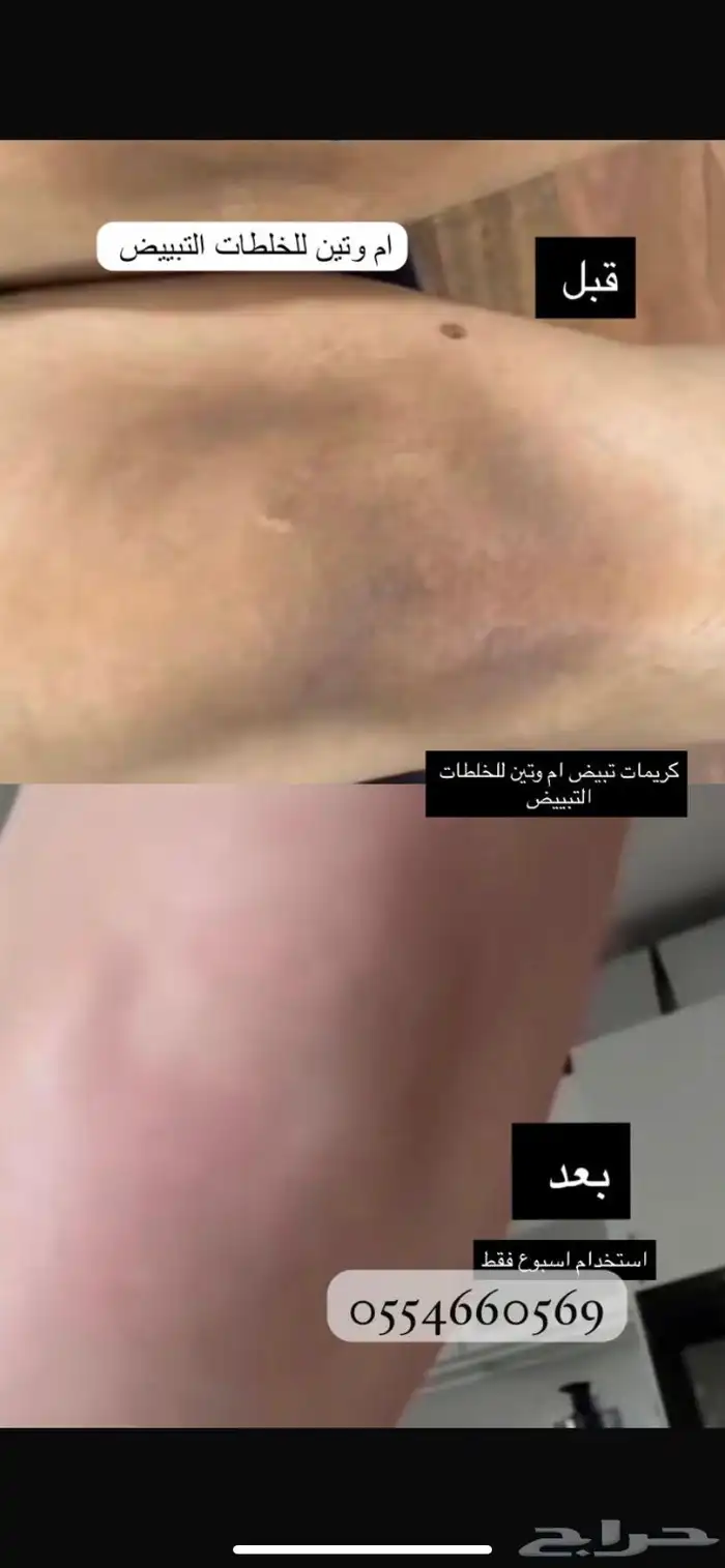 كريمات تبييض في مكة 1