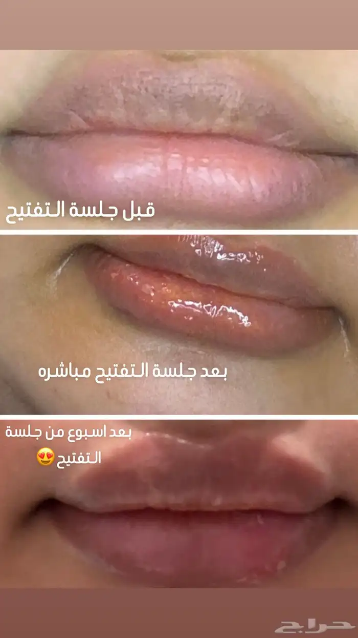 تفتيح الشفايف من جلسه وحده 0