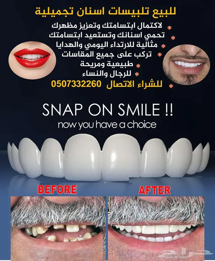 للبيع تلبيسات اسنان تجميلية 0