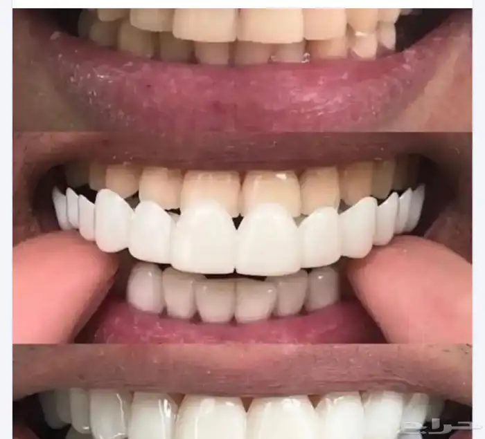 ابتسامة هوليود متحركة 0
