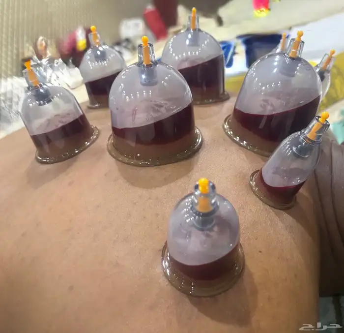 اخصائي حجامه زيارات منزليه 16