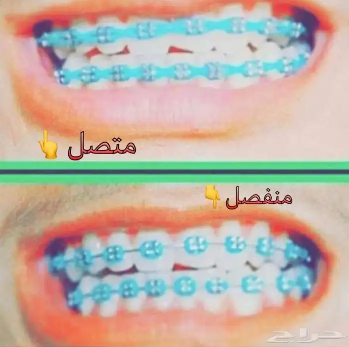 تقويم اسنان زينه 7