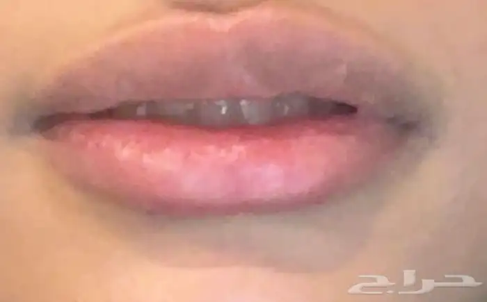 قبل تفتيح وتوريد الشفايف وبعد 0