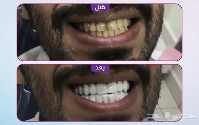 ابتسامة هوليوود المتحركة 4
