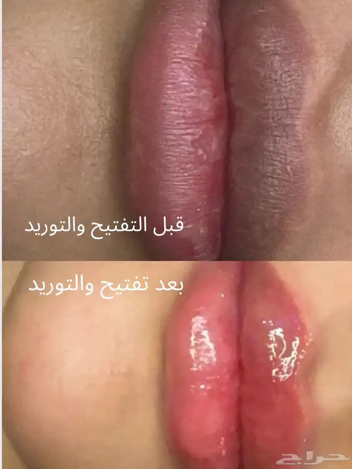 جلسة تفتيح وتوريد الشفايف ب الوان ع ضويه طبيعيه 0