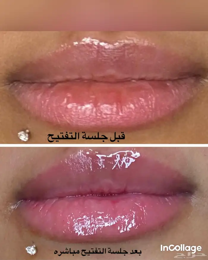 جلسة تفتيح وتوريد الشفايف ب الوان ع ضويه طبيعيه 1