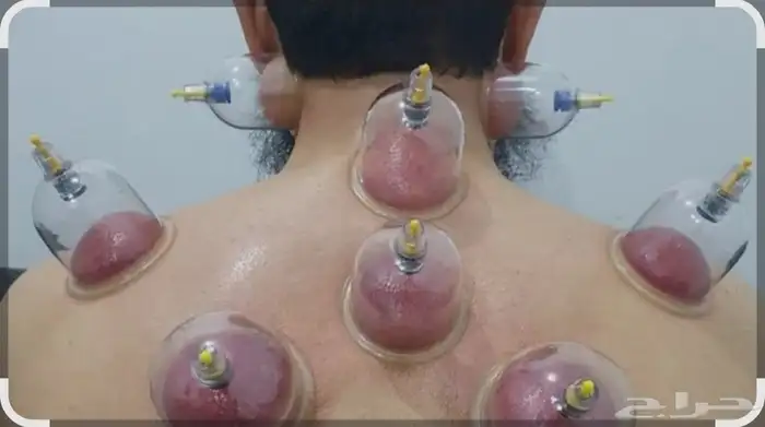 متخصص حجامة 0