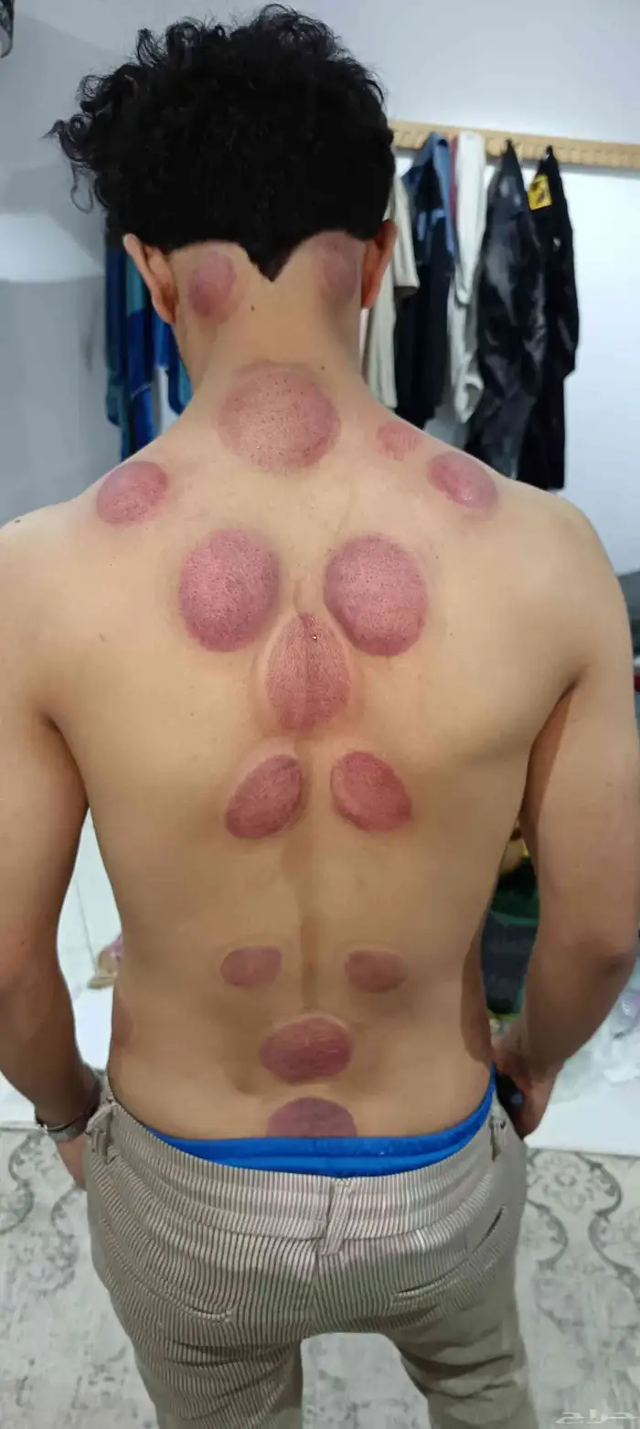 متخصص حجامة منزلية خبرة اكثر من 5 سنوات 7