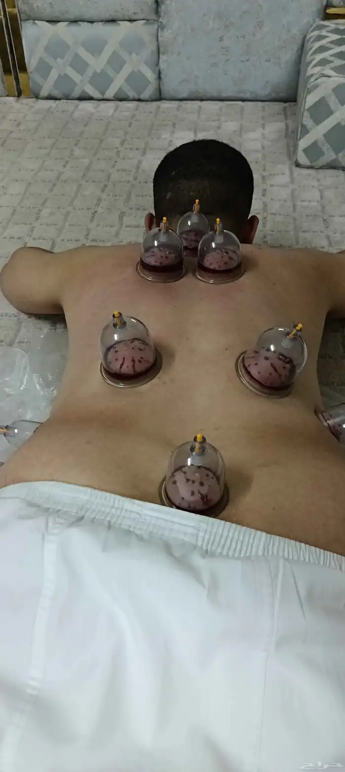متخصص حجامة منزلية خبرة اكثر من 5 سنوات 2