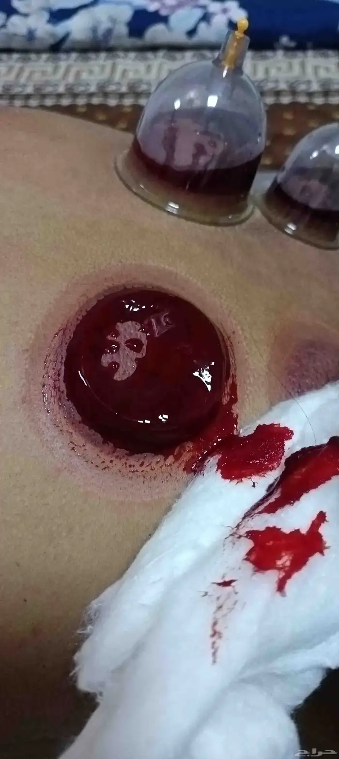 متخصص حجامة منزلية خبرة اكثر من 5 سنوات 3